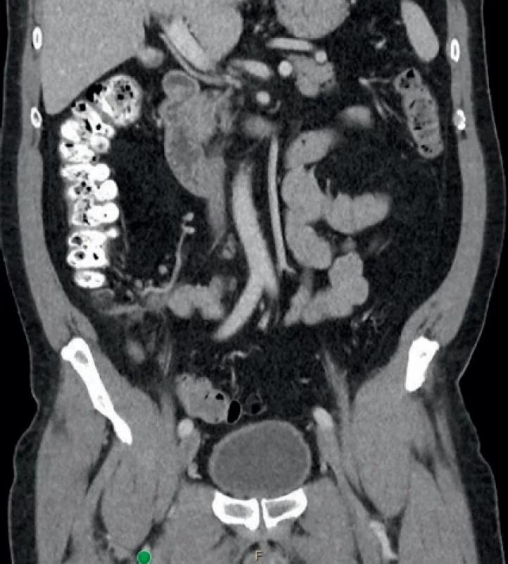  Úspěšně resorbovaný infiltrát na kontrolním CT  po konzervativní léčbě.  A CT scan of a successfully resorbed infiltrate.
