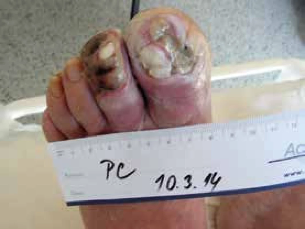 Debridement rány