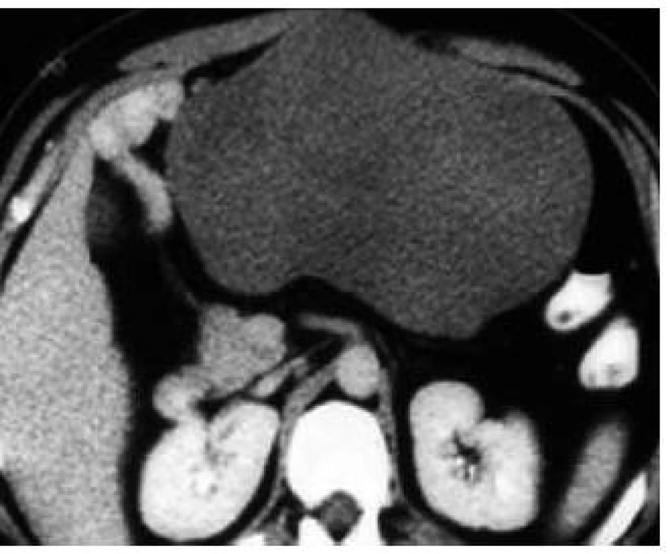 Nález pri CT vyšetrení – hypodenzný útvar mediálne od céka rozmerov 77 × 64 × 37 mm.
Fig. 1. Intra-abdominal CT imaging proved a low density mass 77 × 64 × 37 mm at the medial site of the caecum.
