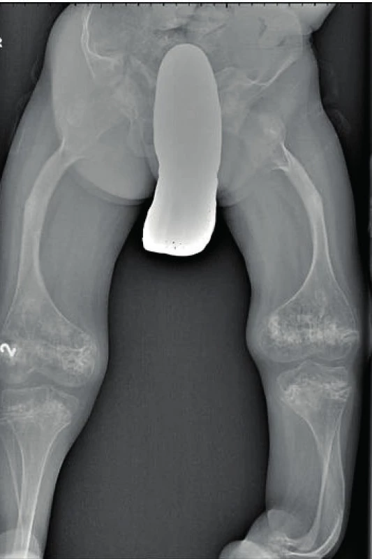 Deformity skeletu dolních končetin u osteogenesis imperfecta III. typu.
Fig. 5. Limb skeletal deformities in osteogenesis imperfecta type III.