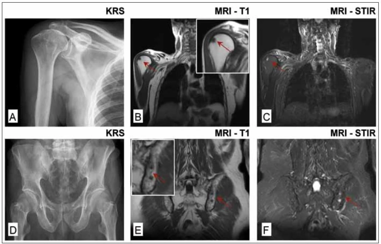 Celotělová magnetická rezonance (WB-MRI) u nemocného s prvotní diagnózou solitární formy plazmocytomu hrudní kosti vycházející z histologického vyšetření materiálu odebraného při parciální resekci sterna. Histologie kostní dřeně z lopaty kosti kyčelní byla negativní, zaznamenána i negativita MIg a normální hodnoty volných lehkých řetězců &amp;kappa; a &amp;lambda; v séru, negativita konvenční radiografie skeletu, <sup>99m</sup>TcMIBI scintigrafie a <sup>18</sup>F-FDG PET/CT.
WB-MRI prokázala na rozdíl od konvenčního radiografického vyšetření pravého humeru a pánve (obr. 1A a 1D) ložiskové léze v hlavici pravého humeru (obr. 1B a 1C) a difuzní postižení pánve a kosti křížové s přítomností 2 ložisek v sousedství sakroiliakálního skloubení (1E a 1F).