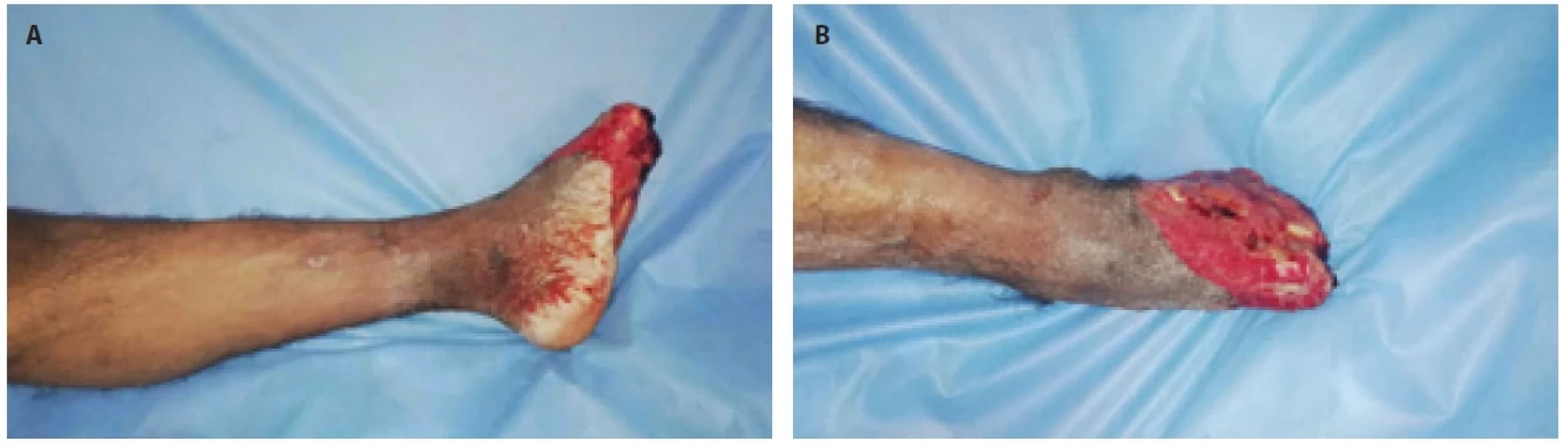 A and B were plantar and dorsal components of the defect.