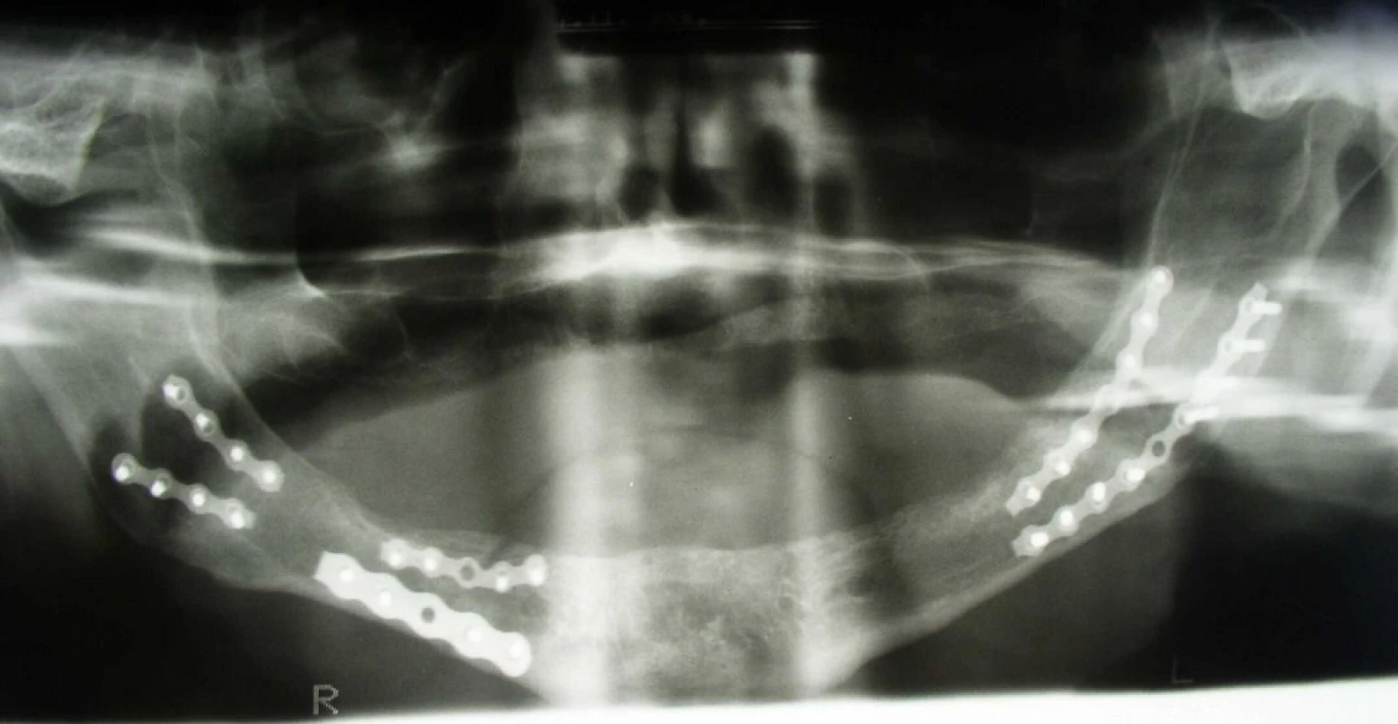 Trojitá zlomenina bezzubé dolní čelisti, ošetřená kombinací rigidní a „miniplate“ osteosyntézy