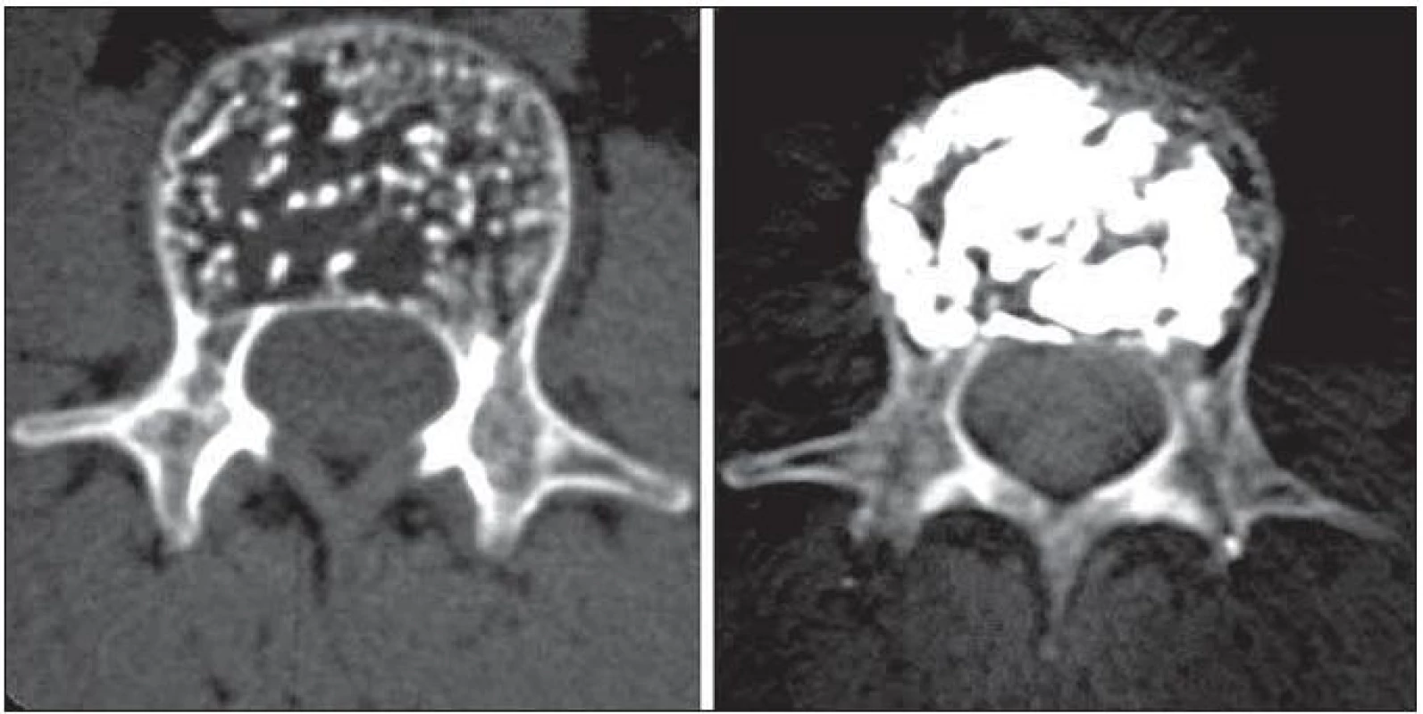 Příklad symptomatického vertebrálního hemangiomu, který invadoval celé obratlové tělo L1.
Radikální výplň přinesla kompletní odeznění bolestí.
