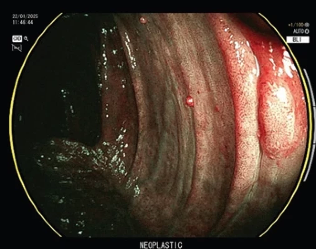 CADx, Fujinon, označení neoplastické léze.