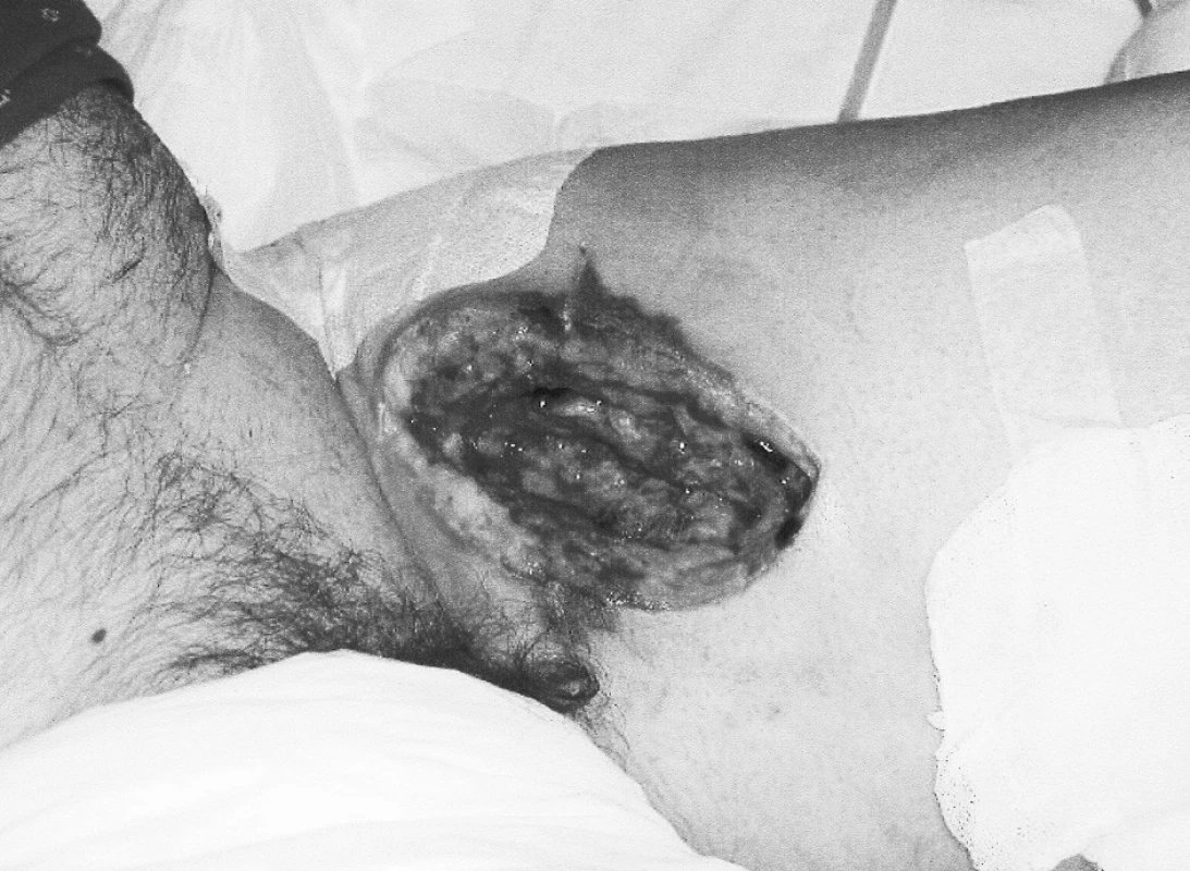 Stav po excízii pseudoaneuryzmy a nekrektómii
Pic. 3. Status following excission of the pseudoaneurysm and necrectomy