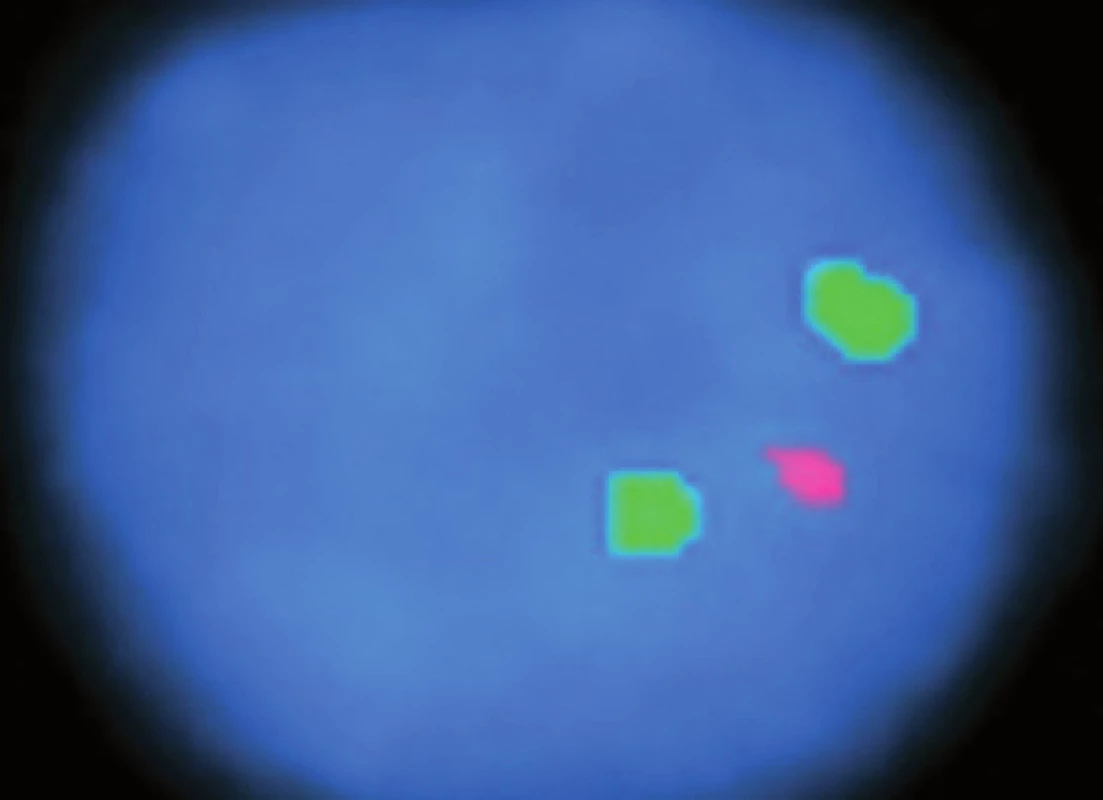 Pozitivní delece 19q13 (fluorescence in situ hybridization).