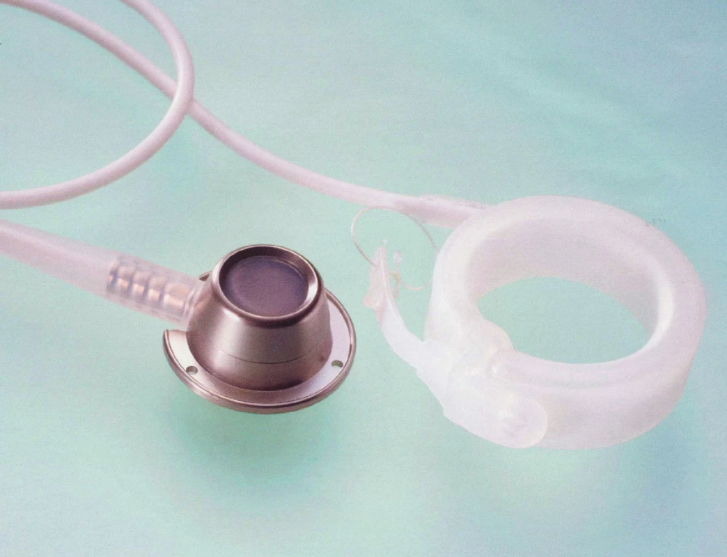 A.M.I. Soft Gastric Band Systém
Fig. 3. A.M.I. Soft Gastric Band System