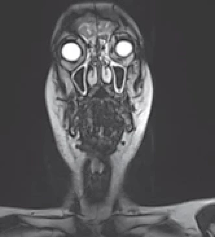 Post-operative MRI – fi rst case.