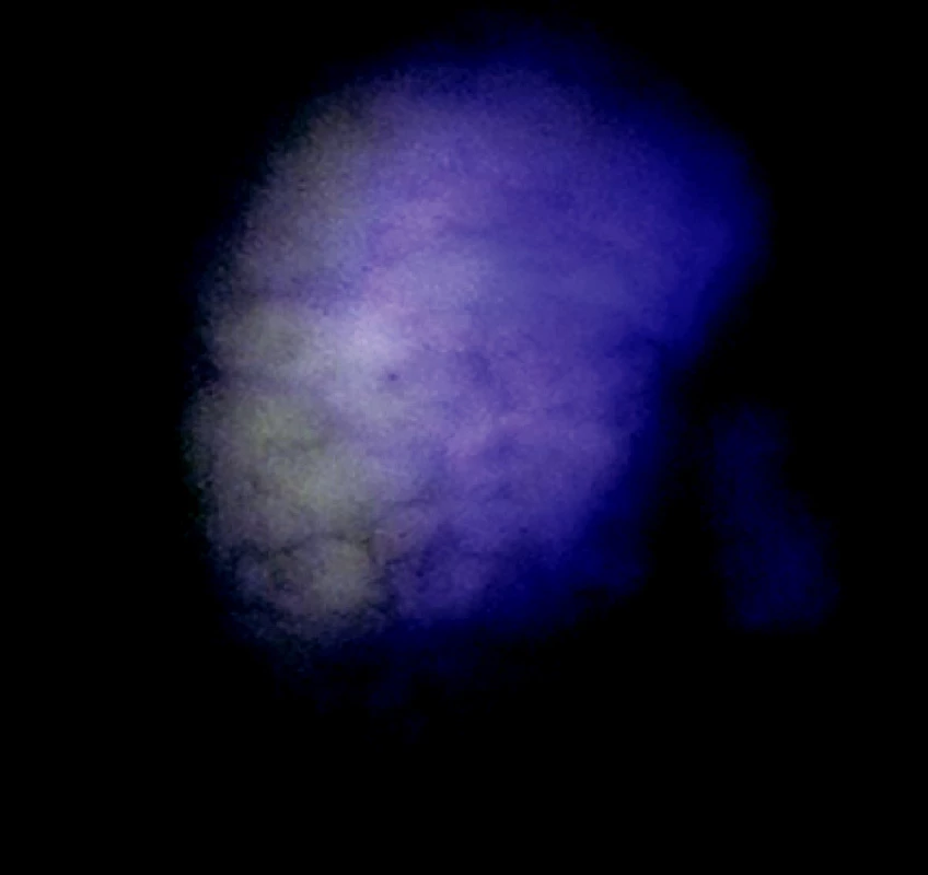 Okraje nádorovej infiltrácie v autofluorescenčnom obraze
Fig. 6. An autofluorescence view of the tumorous infiltration margins