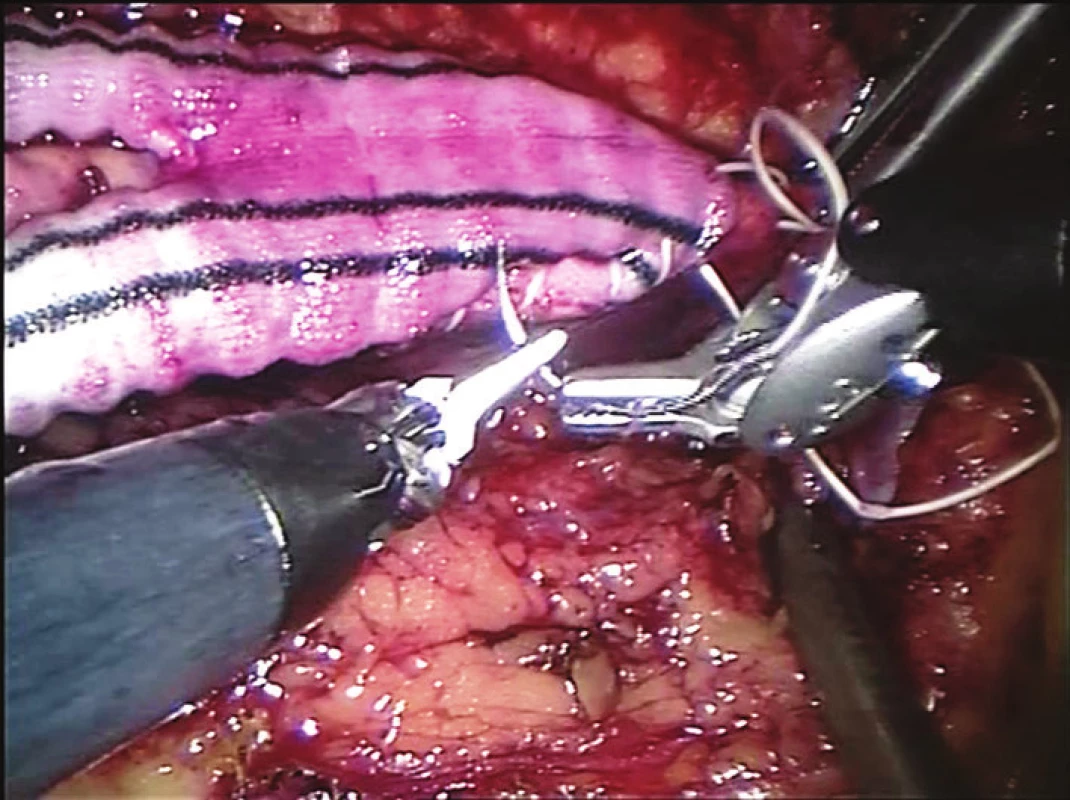 Centrální anastomóza aortobifemorální rekonstrukce (end to side)
Fig. 3: The central end-to-side anastomosis of an aortobifemoral bypass