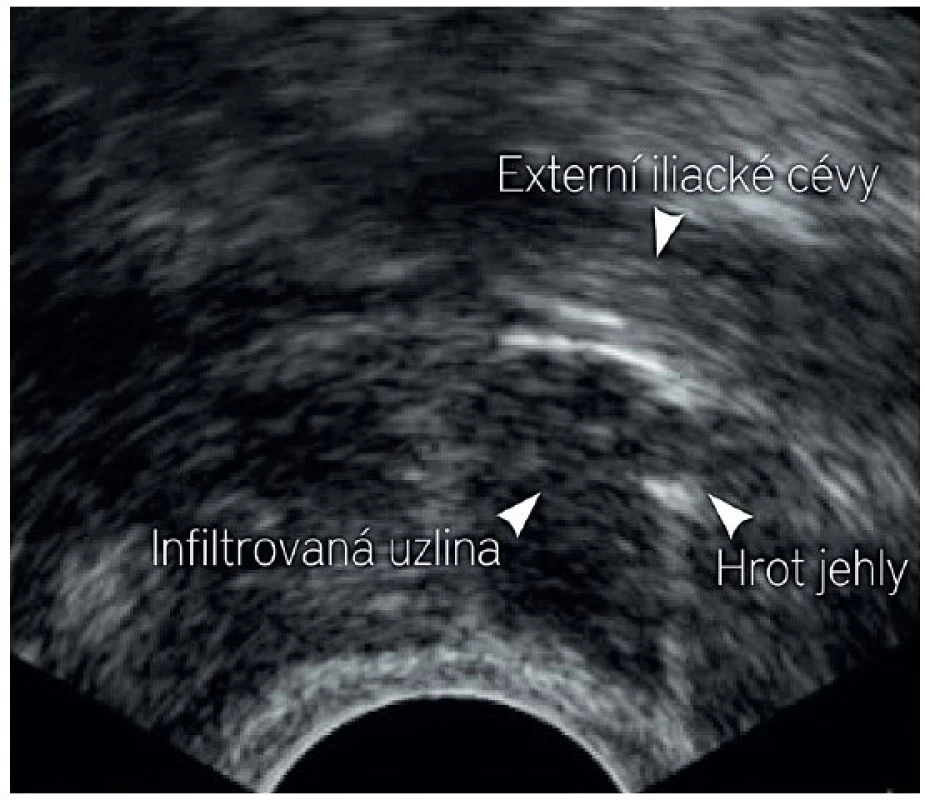 Příklad transvaginální tru-cut biopsie z infiltrované uzliny při externích ilických cévách na levé pánevní stěně.
