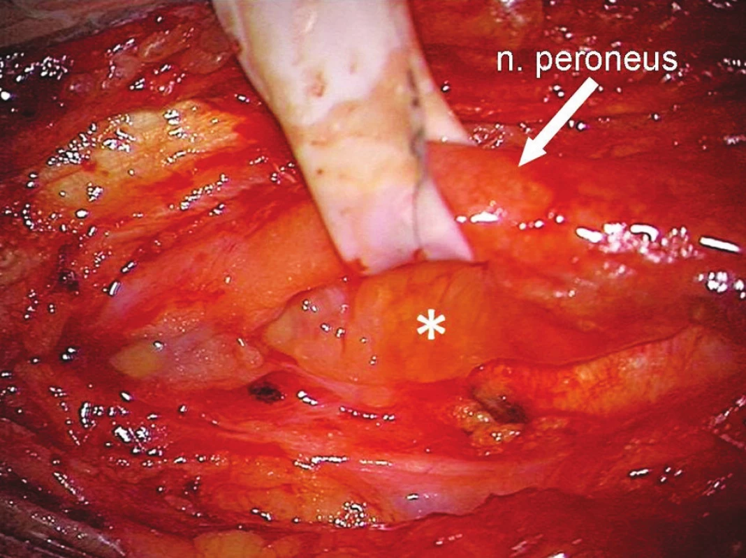 Peroperační nález v podkolení jamce při útlaku n. peroneus communis Bakerovou cystou (*)
Fig. 3. Intraoperative findings within the popliteal fossa upon the peroneal nerve compression by the Baker’s cyst (*)