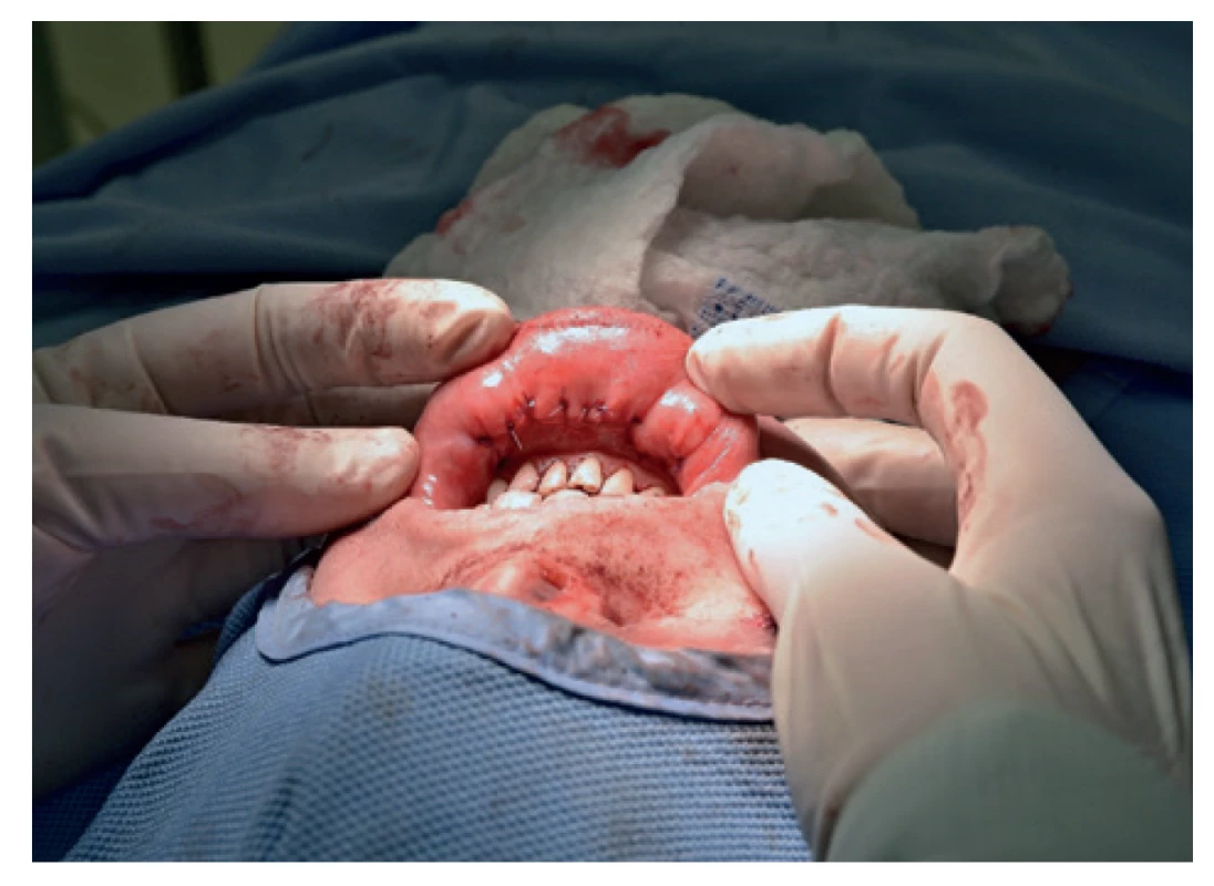 Sutura incizí ve vestibulu<br>
Fig. 5: Suture incisions in the vestibule