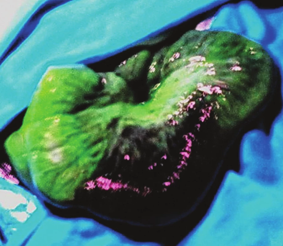 Vitální část střeva emituje žlutozelenou luminiscenci, ischemický segment má barvu tmavě fialovou
Fig. 6. Vital segment of bowel emits yellow green luminescence; ischemic segment has dark violet color