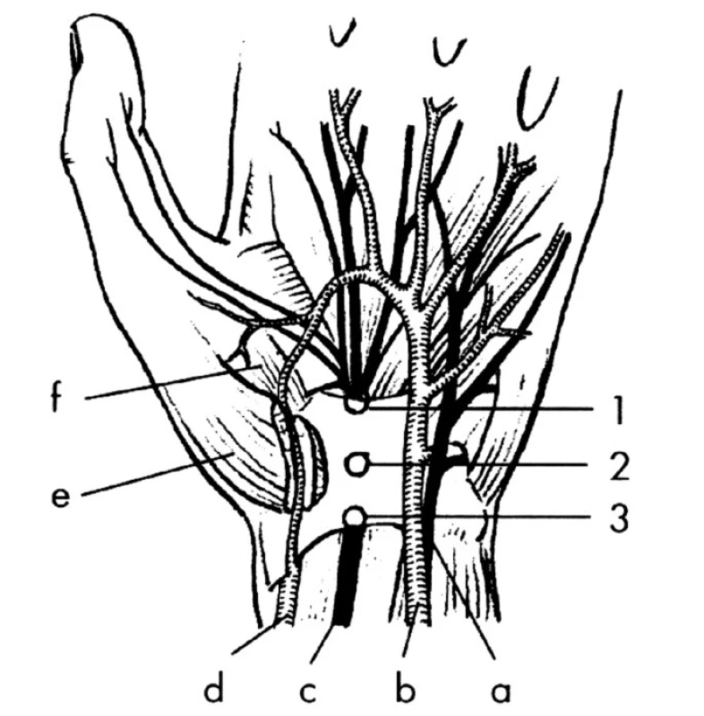 Topografické schéma karpálního tunelu
Úžiny: 1, 2, 3 (v různých místech pod ligamentum carpi transversum).
a – n. ulnaris,
b – arteria ulnaris,
c – n. medianus,
d – arteria radialis,
e – m. abductor pollicis brevis,
f – m. opponens pollicis.