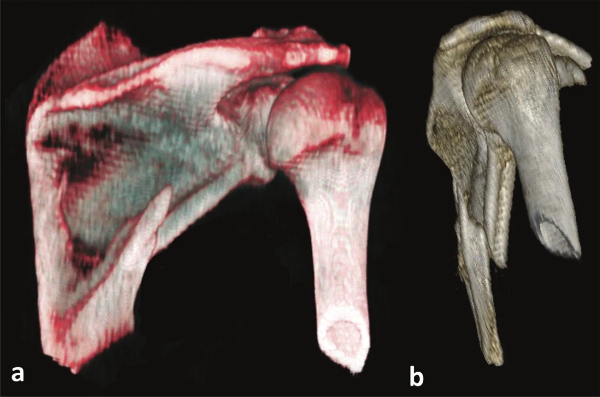 Zlomenina dolní poloviny infraspinátní části těla lopatky
a – zadní pohled, b – laterální pohled.
Fig. 6: Fracture of inferior half of the infraspinous part of scapular body
a – posterior view, b – lateral view.
