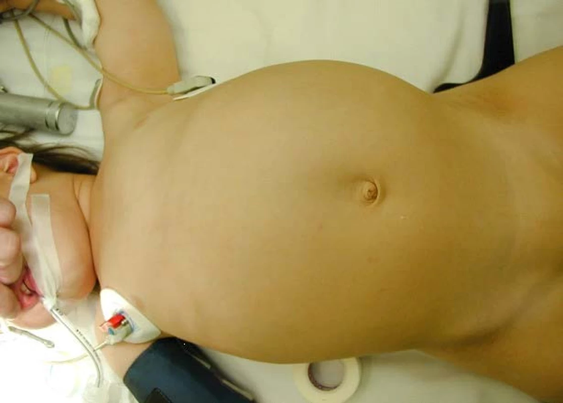 Typický obraz velkého břicha u pacientů s WT
Fig. 1A, B. Typical abdominal distention in patients with Wilms´ tumor