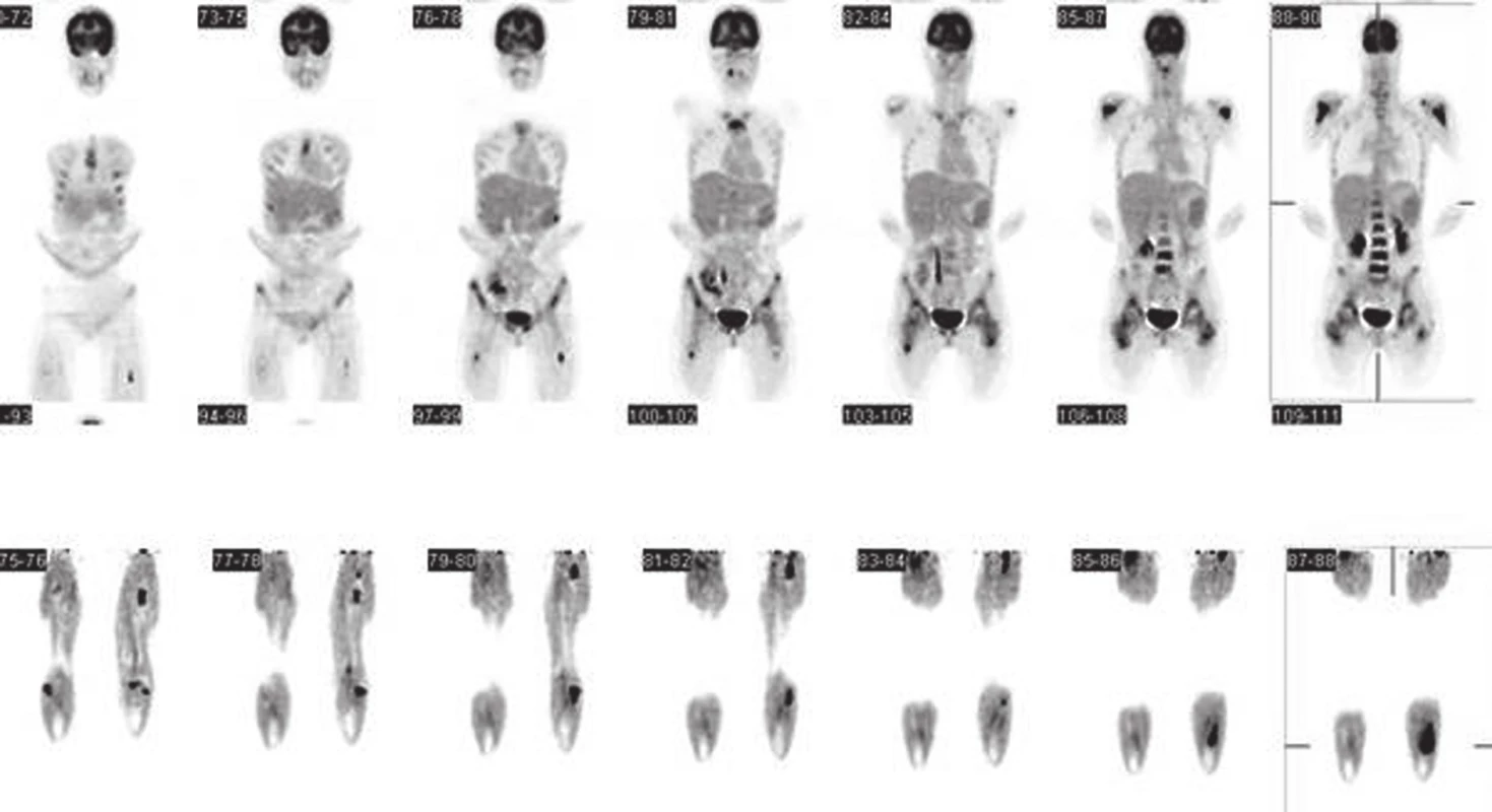 Snímky PET/CT zapůjčeny z Masarykova onkologického ústavu Brno. Pozitronová emisní tomografie trupu <sup>18</sup>F-FDG ze dne 20. 1. 2012 (nález před zahájením terapie dle Ewinga 08). Po aplikaci <sup>18</sup>F-FDG i. v., po 60-ti minutách, snímání emisních a transmisních skenů s korekcí absorpce a iterativní rekonstrukcí dat. Snímání od proximální části stehen výše (horní část obrázku). Snímání dolních končetin (dolní část obrázku). Low dose CT ke korekci atenuace.
Nález hodnocen jako mnohočetná hypermetabolická ložiska ve skeletu s nejvyšší aktivitou v levé fibule. Extraoseálně ložiska hypermetabolismu glukózy t. č. nenalezena.