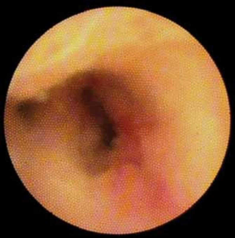 Striktura. Cholangiokarcinom.
Fig. 7. Stricture. Cholangiocarcinoma.