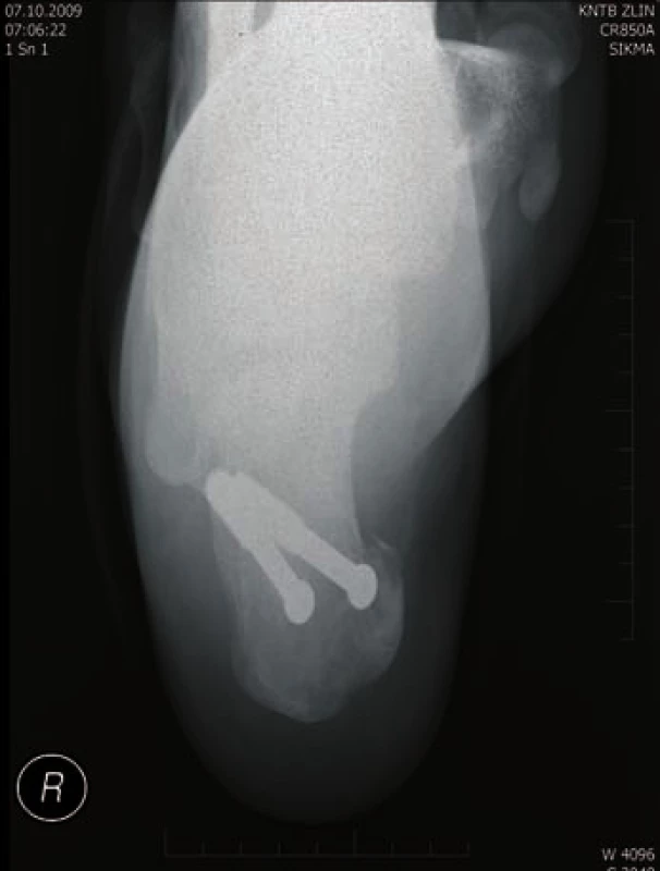 Osteosyntéza AO šrouby - axiální projekce
