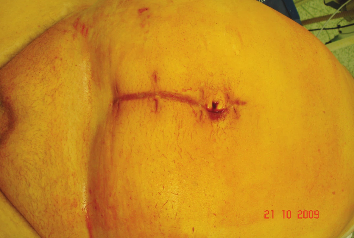 Jizva po první operaci
Fig. 5. A scar following the first procedure