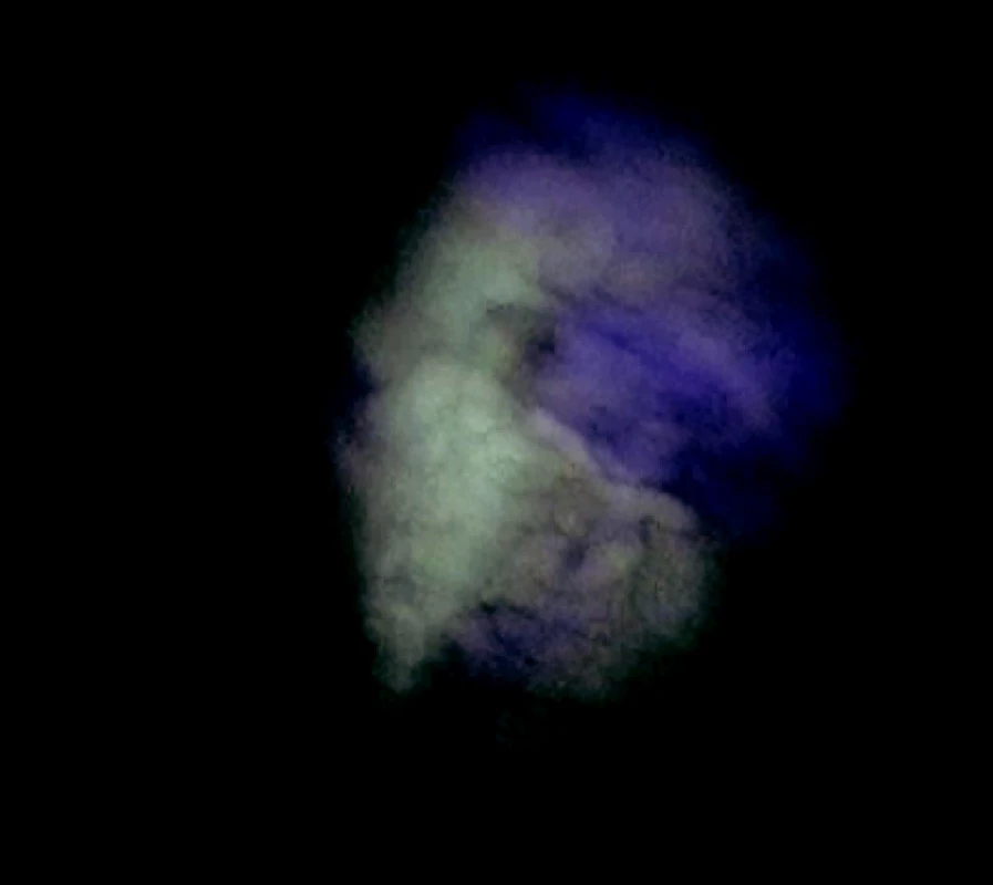 Pohľad na parietálnu pleuru bez postihnutia v autofluorescenčnom obraze
Fig. 2. An autofluorescence view of the unaffected parietal pleura