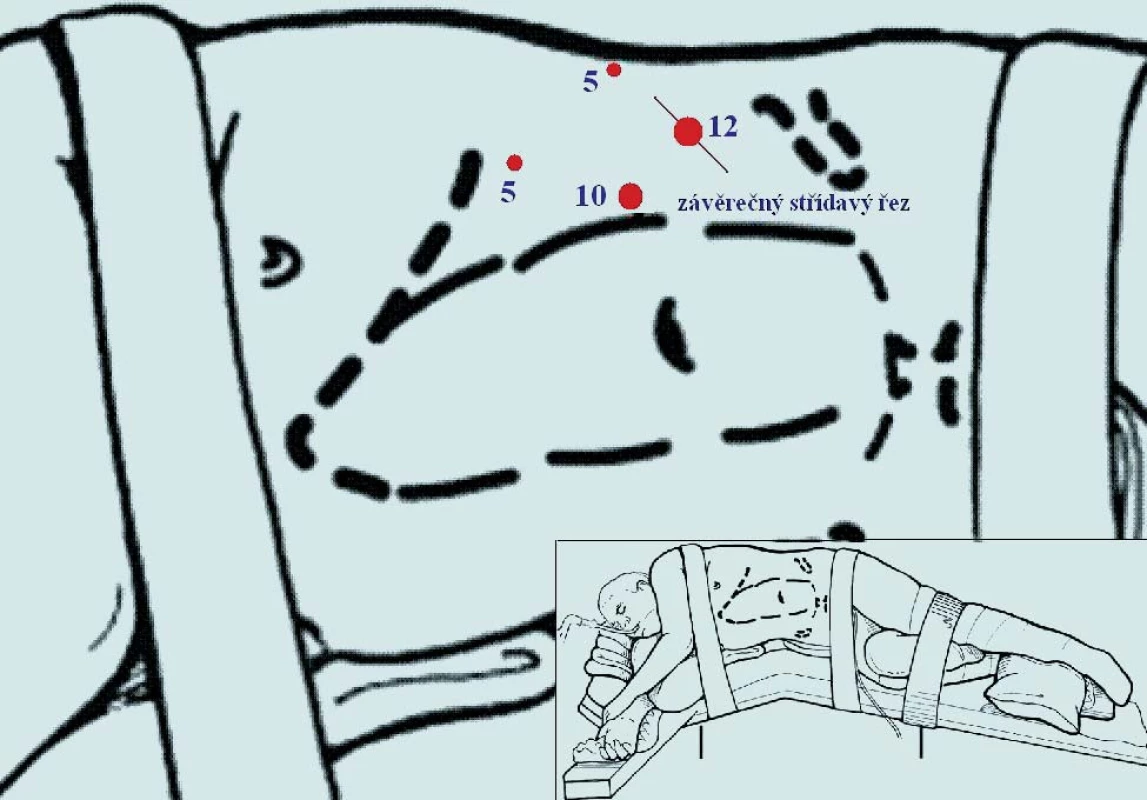 Laparoskopická nefrektomie vpravo. Nejčastější námi užívané rozložení 4 portů.