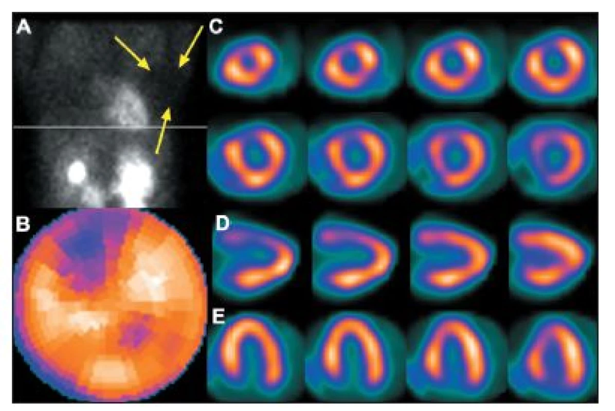 Vyšetření u pacientky s prsními implantáty. Na vybraném snímku z tomografického záznamu (A) je zřetelné zeslabení záření implantátem (šipky), které způsobuje arteficiální defekt perfuze na přední stěně – zobrazeno na polární mapě (B) a vybraných tomografických řezech (C – SA, D – VLA, 
E – HLA).