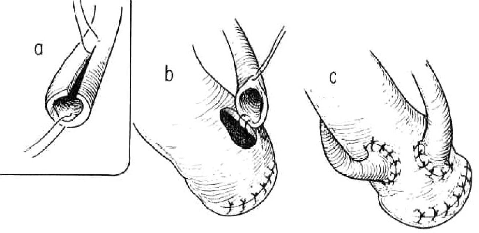 Ureteroileostomie podle Brickera – end to side uretero-ileo anastomoza 
Převzato z: Droller JM. Surgical management of urologic disease an anatomic approach. St.Loius, Mosby – Yaer Book, Inc. 1992: 1150.
Fig. 2: Ureteroileostomy according to Bricker – end-to-side uretero-ileal anastomosis 
According to: Droller JM. Surgical management of urologic disease: an anatomic approach. St.Loius, Mosby-Year Book, Inc. 1992:1150.