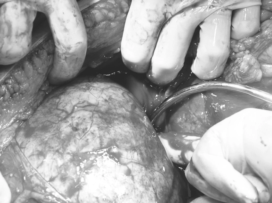 Cystický útvar v operačnom poli
Pic. 4. A cystic formation within the operative field