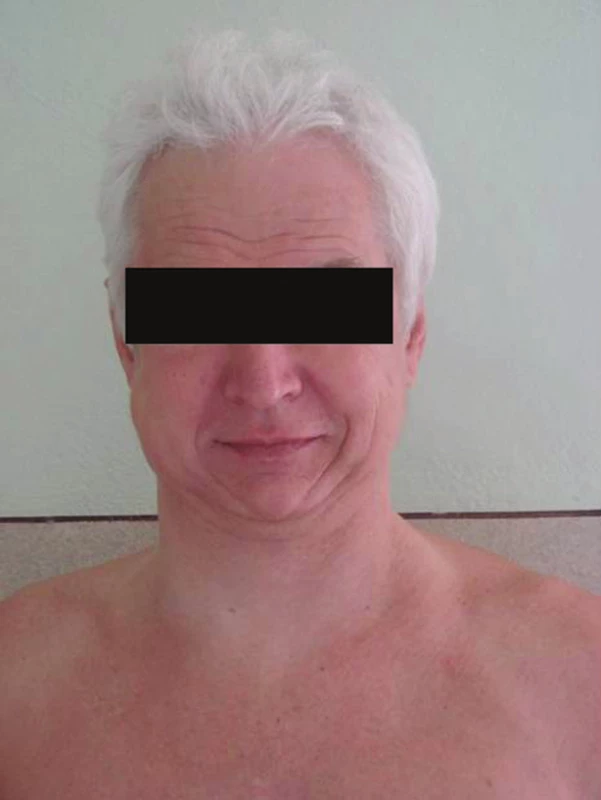 Pacient s podkožním emfyzémem hrudníku a krku
Fig. 1. The patient with subcutaneous emphysema of the neck a thorax