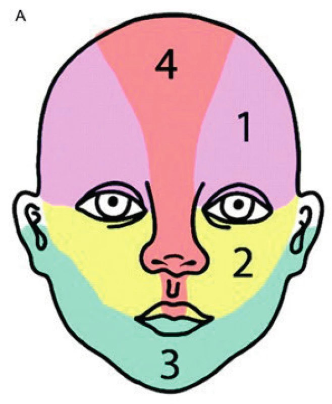 Části obličeje při postižení segmentálním IH. 1 – frontotemporální, 2 – maxilární, 
3 – mandibulární, 4 – frontonazální
Fig. 1. Areas of face involvement by segmental hemangioma. 1 – frontotemporal, 2 – maxillar, 
3 – mandibullar, 4 – frontonasal