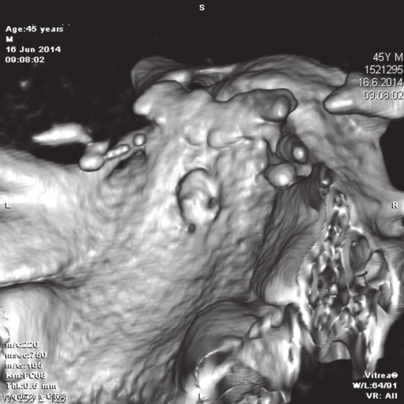3D rekonstrukce: pohled na posteriorní aspekt klivu, kde je patrná fraktura
Fig. 2: 3D reconstruction: view of the posterior aspect of the clivus where its fracture is visible
