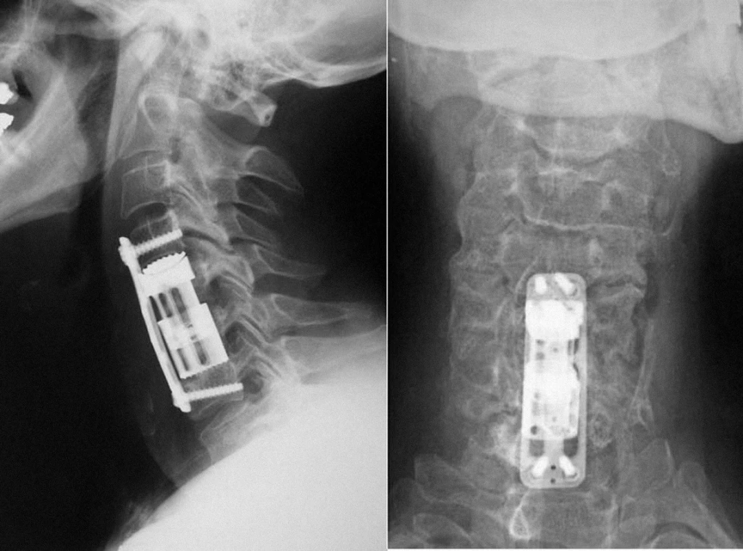 Teleskopický distrakční koš Te-Corp<sup>®</sup> užitý u pacienta k rekonstrukci defektu po odstranění obratlových těl C5 a C6. Konstrukce implantátu pro krční páteř umožňuje ve třech provedeních náhradu defektu předního sloupce v rozsahu 20–61 mm. Kraniální komponenta obsahuje úhlově nastavitelnou lištu konvexního profilu, která je konstrukčně přizpůsobena k tomu, aby dokonale dosedla na kontaktní plochu kraniálního obratle.