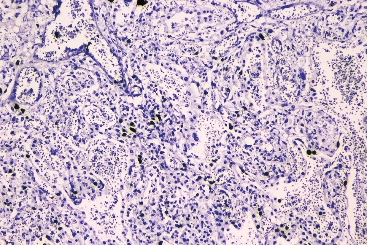 Imunohistochemický dôkaz Ki-67 so zvýšenou proliferačnou aktivitou takmer vo všetkých súčastiach (imunohistochémia Ki-67, zväčšenie 100x). pľúc
