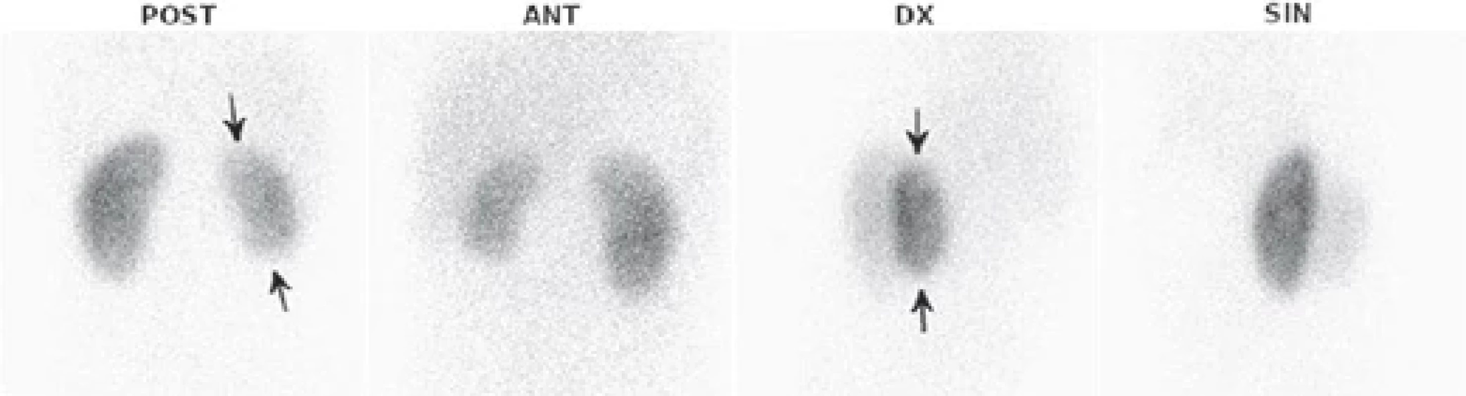 Základní 4 projekce statické scintigrafie ledvin u 6leté dívky, sledována od 6 měsíců věku s dg. VUR III.–IV. stupně l. dx. Normální nález vlevo, pravá ledvina zřetelně menší se separovanou funkcí 35 % a s redukcemi funkční tkáně v horním a dolním pólu ledviny