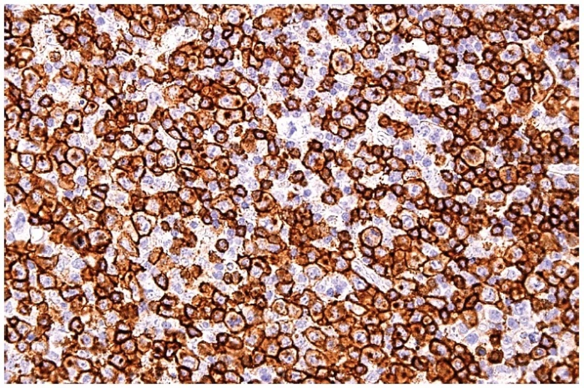 Molekula CD8 na buněčných membránách a s bodovou pozitivitou cytoplazmy blasticky aktivovaných T lymfocytů. Imunohistochemická reakce, dobarveno hematoxylinem (zvetšení 200x).