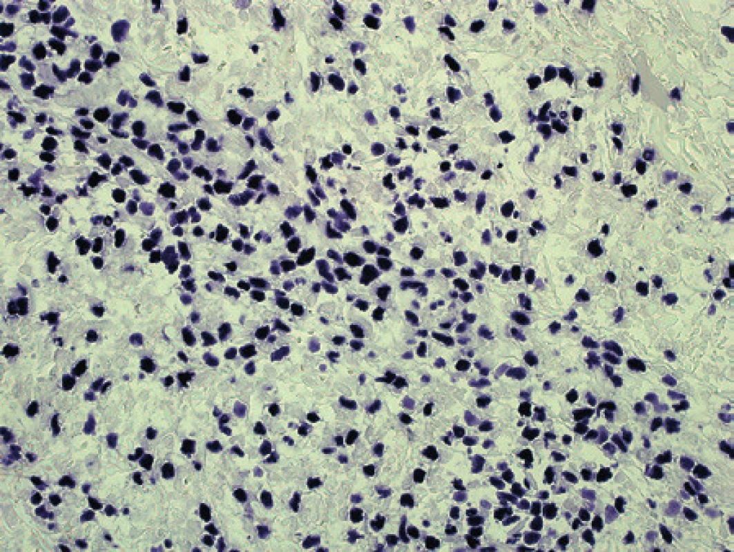Pacient 5. Průkaz EBER v jádrech nádorových lymfocytů.
Chromogenní <em>in situ</em> hybridizace – vizualizace vazby sond tetrazoliovou modří (původní zvětšení 100x).