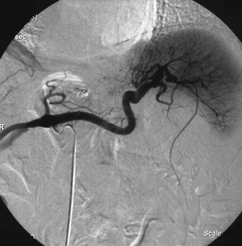 Katetrizační angiografický obraz neprokazující promývané pseudoaneuryzma v době jeho spontánní trombózy
Fig. 3. Cathetrization angiography not detecting the contrast-filled pseudoaneurysm at the time of its spontaneuos thrombosis 