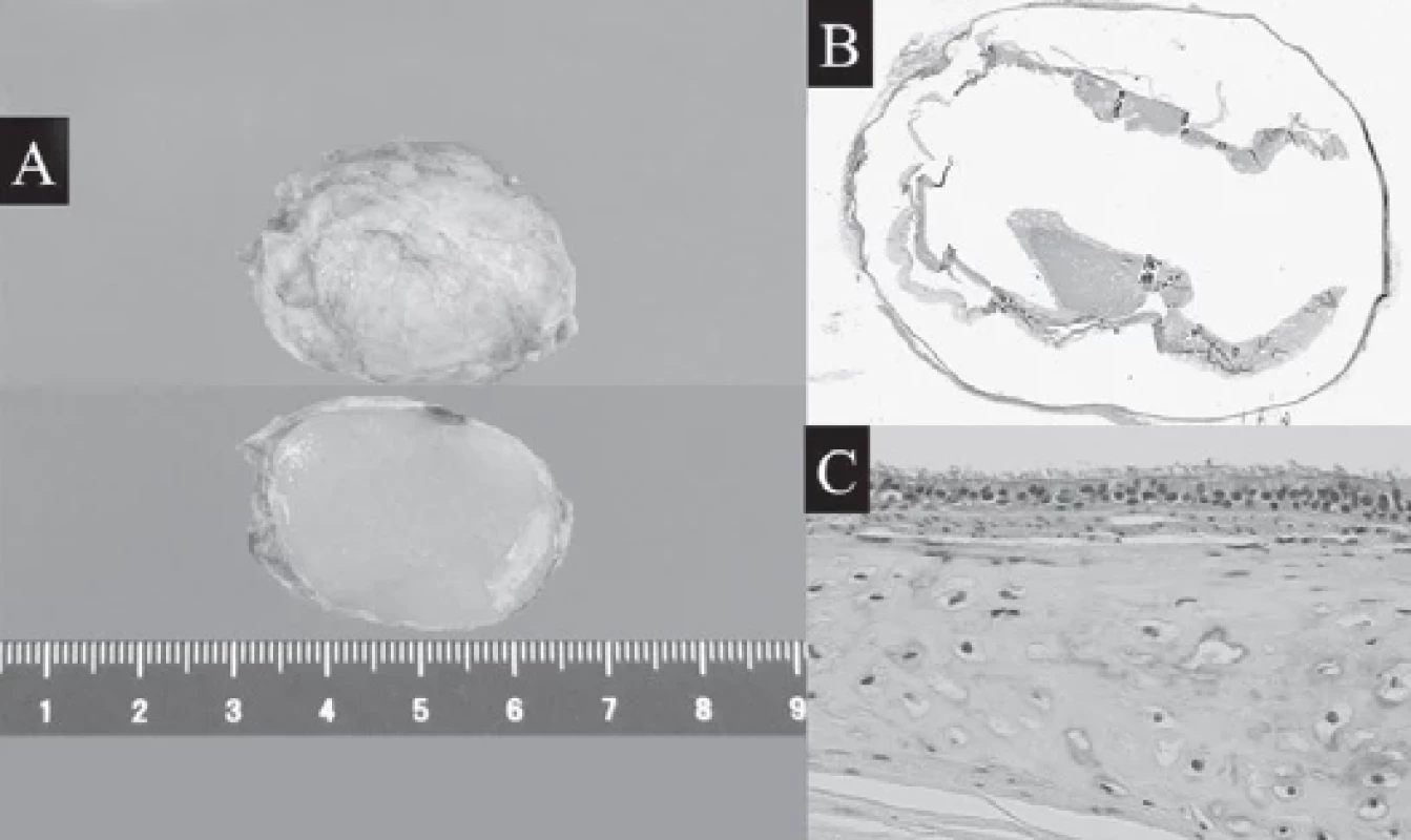 Surface of the resected lesion (A-upper). The size of the cyst was 35 × 25 × 20 mm. Cut surface of the lesion (A-lower). A hyaline- like stroma was observed inside the cyst wall. Low-power photomicrograph (B) and high-power photomicrograph (C) after formalin fi xation. The inner surface of the cyst was covered with ciliated columnar epithelium and there were sites where lymphocytes were gathered. Cartilage tissue was confi rmed in some parts.