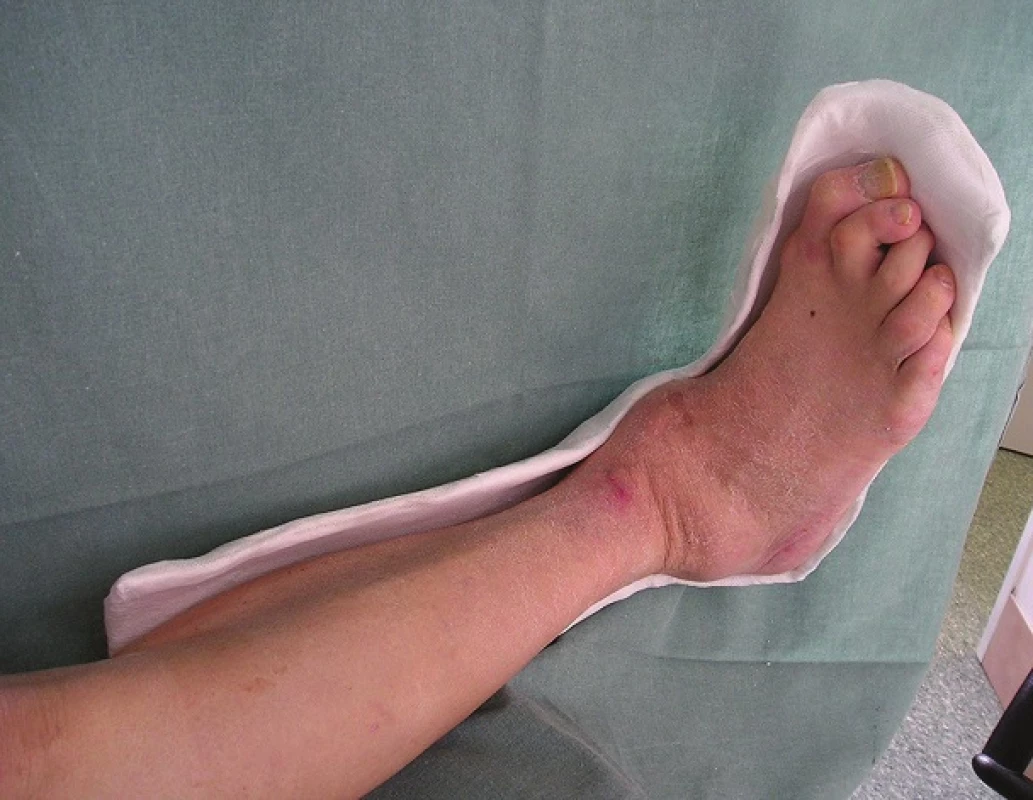 Dorzální snímatelná dlaha
Fig. 4: Dorsal removable contact L-splint (L-RCS)
