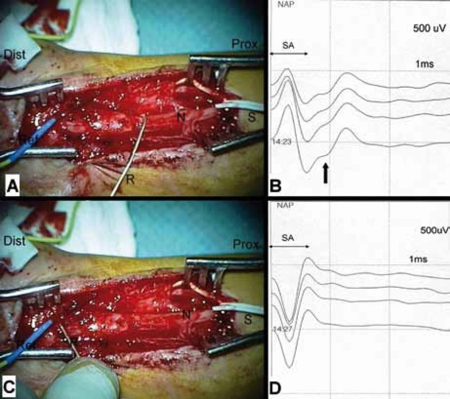 Intraoperační snímání nervového akčního potenciálu (NAP). 
Stav po řezném poranění n. medianus (N), trvá úplný denervační syndrom, patrný neurom v kontinuitě. Nerv vypreparován v dostatečném rozsahu pro neurografii. A, B: Vyšetření vodivosti proximálního pahýlu – bipolární stimulace (S) na proximálním pahýlu v proximálním pólu rány, monopolární registrace (R) háčkovou elektrodou proximálně od neuromu. Registrován NAP následující po stimulu artefaktu (SA). C, D: Vyšetření vodivosti přes neurom – stimulace identická, registrace distálně od neuromu. Odpověď (NAP) není výbavná – blok vedení.