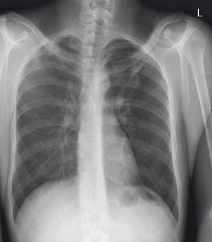 Regrese radiologického nálezu při terapii antituberkulotiky.
Fig. 2. Radiographic regression during treatment with antituberculotic drugs.