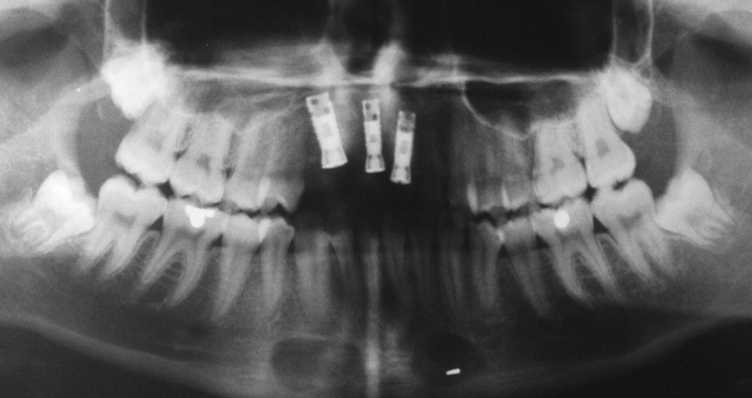 RTG po implantaci.Nápadná je disparalelita os jednotlivých fixtur, která ztěžovala dosažení paralelity os budoucích pilířových konstrukcí můstku.