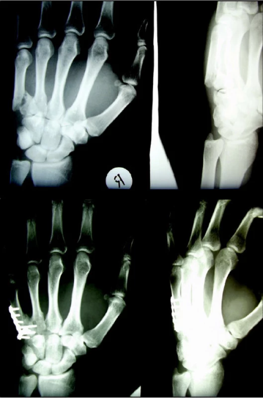 Extraartikulární zlomenina proximální epifýzy (a) stabilizována dlahovou osteosyntézou (b)