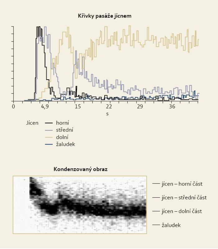 Příklad antiperistaltiky a retence v dolní části jícnu.
Fig. 6. Example of antiperistalsis and retention in lower part of oesophagus.