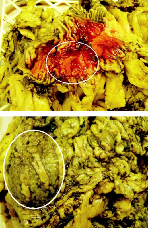 Myotické ložisko v resekátu střeva
Fig. 5. Myotic focus in the colon resecate
