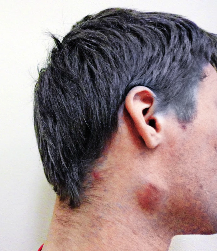 Zvětšená uzlina na pravé straně krku se zarudnutím nad uzlinou u našeho 19letého pacienta
Figure 2. Enlarged nodule on the right side of the neck with redness above the nodule in our 19-year-old patient