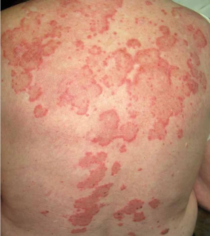 Anulární subakutní kožní erythematodes